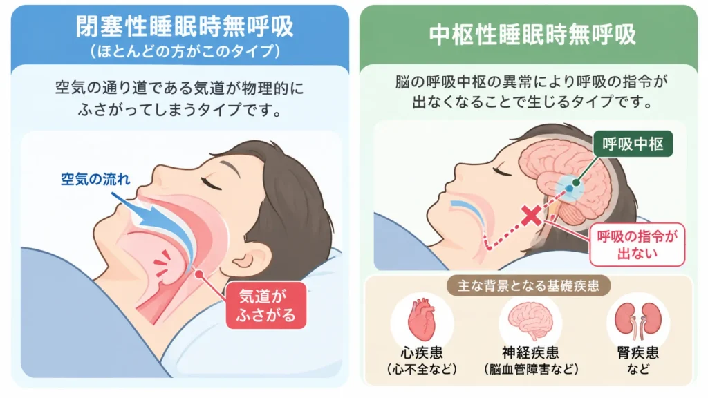 睡眠時無呼吸症候群のタイプ